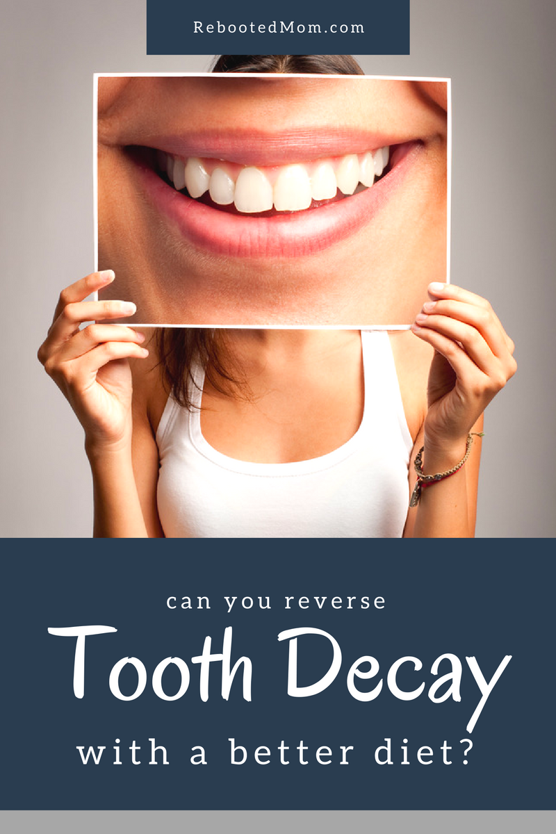 Can you Reverse Tooth Decay with a Better Diet?